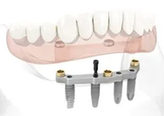 Implant supported Dentures