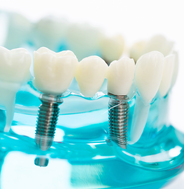 Dental Problems Solved by Implants