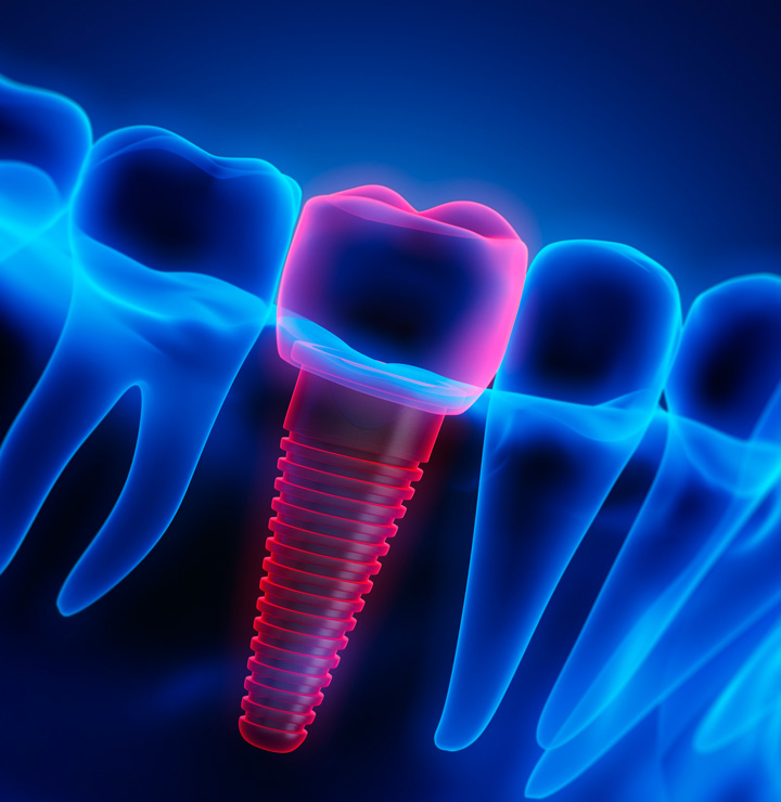 Dental Problems Solved by Implants