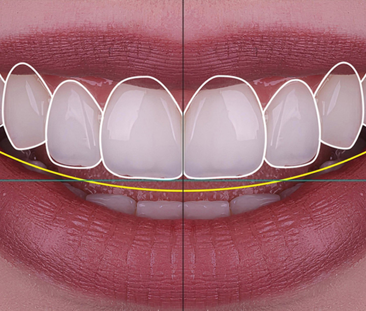 Dental Treatments Included in a Smile Makeover